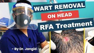 Wart Removal on Head  Live RFA Wart Removal Treatment  Dr Jangid [upl. by Siddon]