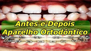 Aparelho Ortodontico Antes e Depois  Dentes Separados [upl. by Celina]