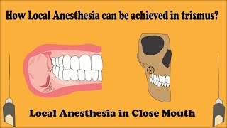 Close Mouth Mandibular block  Vazirani Akinosi technique [upl. by Dnalwor]