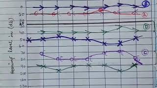 Audiogram  Assessment of Type of Hearing Loss  Part 2 [upl. by Sackey63]