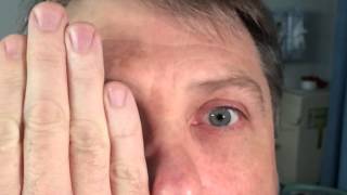 Gaze Holding Nystagmus Vestibular Examination [upl. by Zamir]