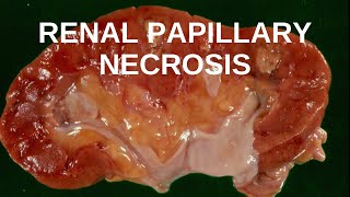 Renal Papillary Necrosis  Pathology mini tutorial [upl. by Viridi]