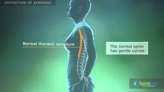 Kyphosis Definition [upl. by Blalock]