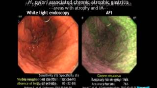 Advanced Imaging in the Diagnosis of Gastric Intestinal Metaplasia The Experts Approach [upl. by Seroka]