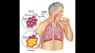 Probiotics Bifidobacterium Breve amp Lactobacillus Rhamnosus Helps Asthma  Inflammation T cell [upl. by Ailisab]