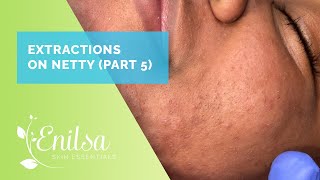 Blackhead Extractions on Netty  Fifth Treatment [upl. by Hannej]