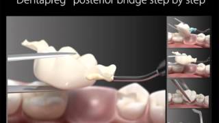 Dentapreg Posterior Bridge Training [upl. by Anivlek]