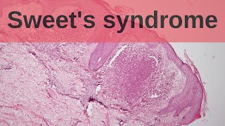 Sweets Syndrome  Pathology mini tutorial [upl. by Suiravat]