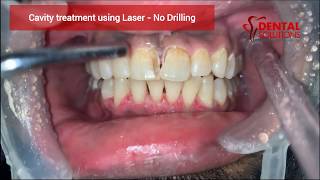 Tooth cavity filling without drilling  Laser caries treatment  Contactless cavity filling [upl. by Ecilegna]