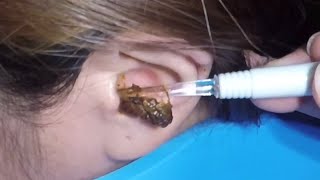 The Most Massive Earwax Removed in One Scoop [upl. by Maribelle]