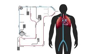 Modified Thermodilution in Extracorporeal Therapy [upl. by Llewon950]