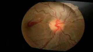 Yag Laser Hyaloidotomy for a pre macular haemorrhage [upl. by Aierb116]