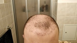 I Stopped Taking Finasteride after Hair Transplant  1 Year Hair Loss Experiment [upl. by Dasa]