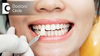 Can veneers replace missing teeth Dr Kusum Bashetty [upl. by Ronoh]