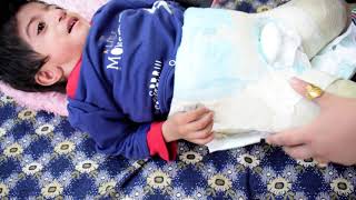 DDH Open Reduction Surgery  Spica Cast  How to diaper in Spica Cast  Arthrogryposis DDH Pakistan [upl. by Ranita]