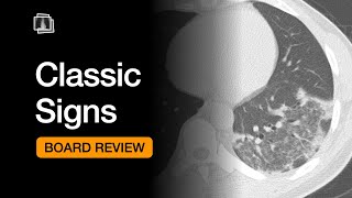 Classic Signs  Chest Radiology Board Review [upl. by Ylrahc]