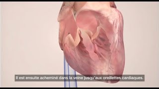 La fibrillation atriale  Ablation par Cathéter [upl. by Vincenta]