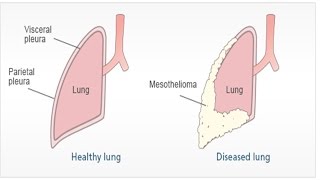 Pleural Mesothelioma  Asbestosis Symptoms and Treatment  Malignant Peritoneal Mesothelioma [upl. by Gaspar953]