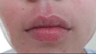 How to get rid of Perioral Dermatitis [upl. by Katine]