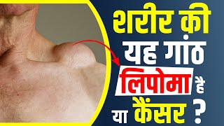 Lipoma vs Cancer Lump  Lipoma Treatment in Homeopathy in Hindi  What is Lipoma Cyst [upl. by Sheffield454]