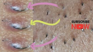 Ingrown hair  thick facial hair extraction [upl. by Gennaro180]