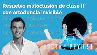 Maloclusión de clase II resuelta con ortodoncia invisible [upl. by Eimat]