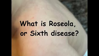 Roseola or Sixth disease [upl. by Elyagiba]