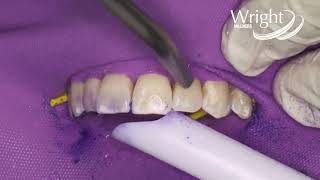 Opalustre by Ultradent with Dr H Seedat [upl. by Egwin]