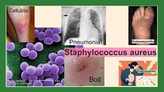 Staphylococcus aureus [upl. by Crescin]