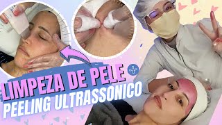 Limpeza de pele com peeling ultrassônico  Antes e Depois [upl. by Mihar]