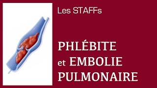 Phlébite et Embolie pulmonaire  12  STAFFs Saint Camille [upl. by Thielen]