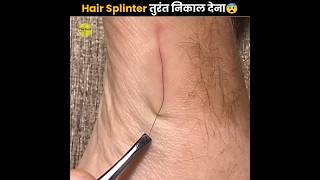 Remove Hair Splinter Immediately⚠️ [upl. by Kina]