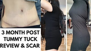 TUMMY TUCK SCAR AND BEFORE AND AFTER PICTURES  PLASTIC SURGERY UPDATE [upl. by Frodeen825]