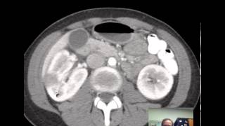 CT Kidneys and Bladder  Five pathologic cases discussed [upl. by Charlot]