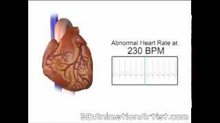 Normal Vs Accelerated Heart Rate [upl. by Uliram]