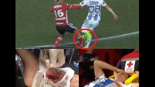 Terrible Lesión del CHUCKY Lozano  Horrible Injury [upl. by Birck]