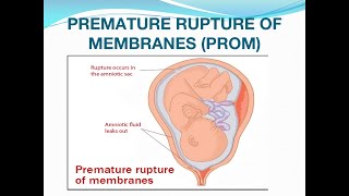 Premature rupture of membranes PROM [upl. by Silecara]