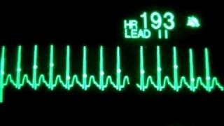 Taquicardia supraventricular con cardioversión sincronizada AS [upl. by Ecyarg]