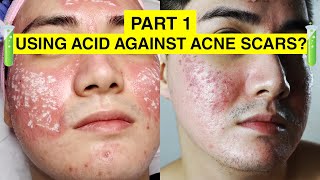 USING ACID TO GET RID OF ACNE SCARS  My TCA CROSS Experience Philippines  Envi Beauty Part 1 [upl. by Aube71]