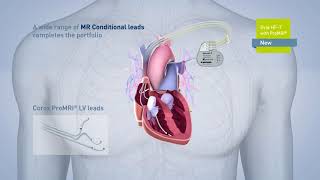 Biotronik pacemaker EVIA [upl. by Soelch309]