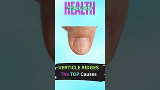 VERTICLE RIDGES on Nails The TOP Causes shorts shortsfeed ytshorts health facts [upl. by Yelsnit115]