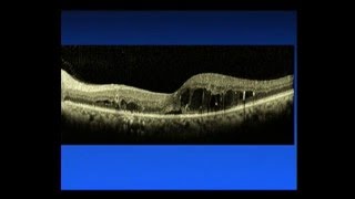 Medication Injection and Laser Surgery for Macular Edema [upl. by Grefer]