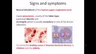 Streptococcus pneumoniae infection and disease [upl. by Eerac542]