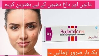 Acdermin gel for acneHonest review Best solution for acne medicated [upl. by Novello]