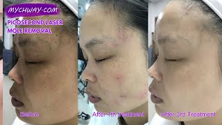 Atypical Moles What Are They Dermatology 2019 [upl. by Frum810]