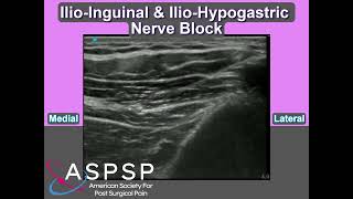 Ilio Inguinal amp Ilio Hypogastric Nerve Block [upl. by Eenolem]