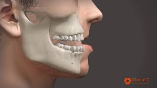 LEFORT 1  OSTEOTOMY  ORTHOGNATHIC SURGERY [upl. by Gluck]