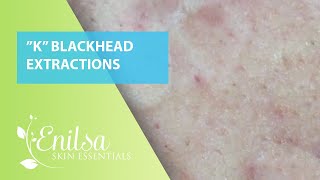 Blackheads Extractions “K’s” 6th Treatment [upl. by Liagibba935]