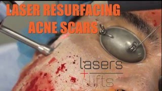 TCA Cross FULL TREATMENT for Acne Scars  Los Angeles [upl. by Wini72]