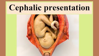 cephalic presentation [upl. by Ainad151]